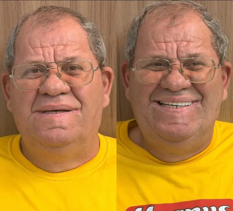 Paciente antes e depois da prótese protocolo feita na Sorriclin